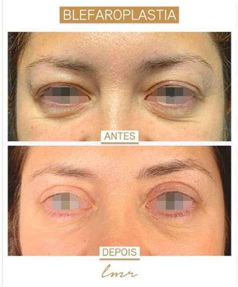 blefaroplastia valor - honestidad valor